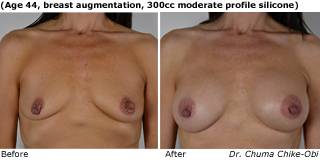 patient w breast augmentation front