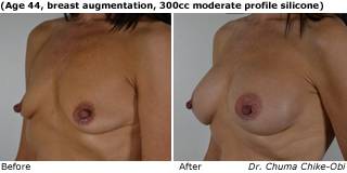 patient w breast augmentation quarter
