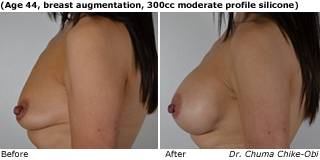 patient w breast augmentation side
