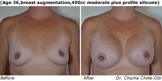 patient k breast augmentation front