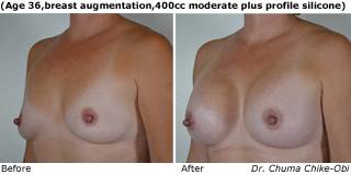 patient k breast augmentation quarter