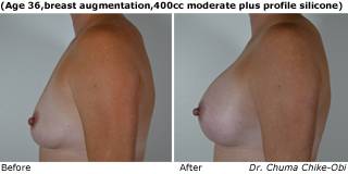 patient k breast augmentation side