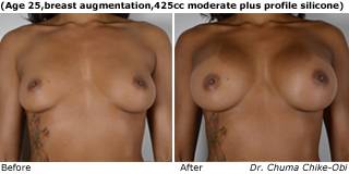 patient o breast augmentation front