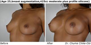 patient o breast augmentation quarter