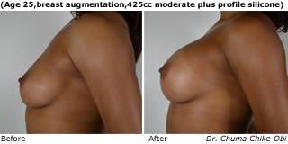 patient o breast augmentation side