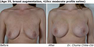 patient d breast augmentation front