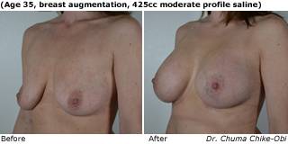 patient d breast augmentation qurter