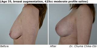 patient d breast augmentation side