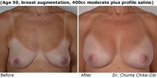 patient N breast augmentation front
