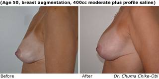 Patient N Silicone Before and After