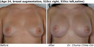 patient h breast augmentation front
