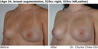 patient h breast augmentation qurter