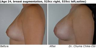 Patient h Silicone Before and After