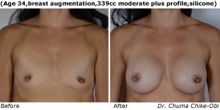 patient s breast augmentation front