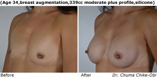 patient s breast augmentation quarter