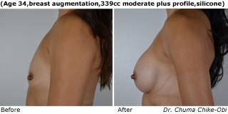 patient s breast augmentation side