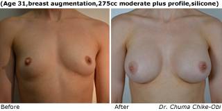 patient g breast augmentation front