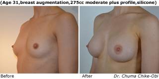 patient g breast augmentation quarter