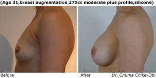 patient g breast augmentation side