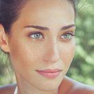 melasma