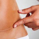 prevent scars