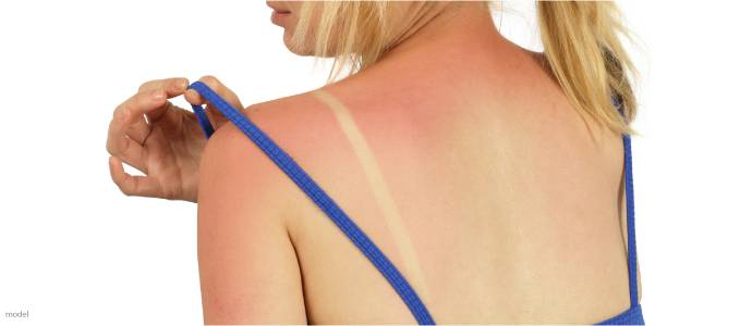 Bad Sunburn Image