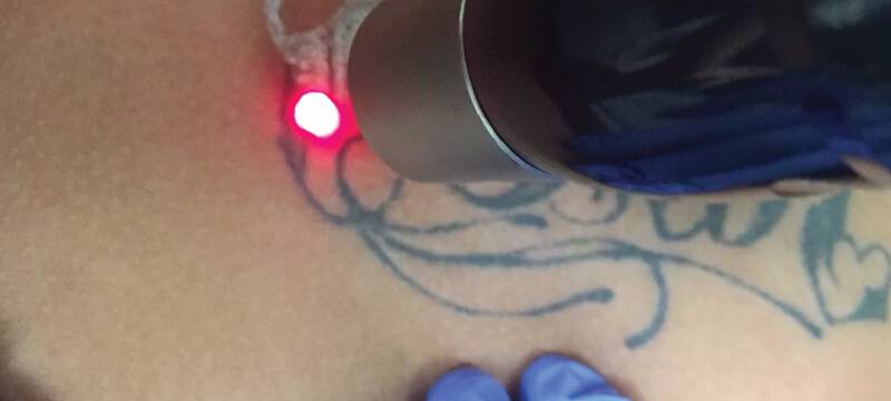 tattoo removal FAQ