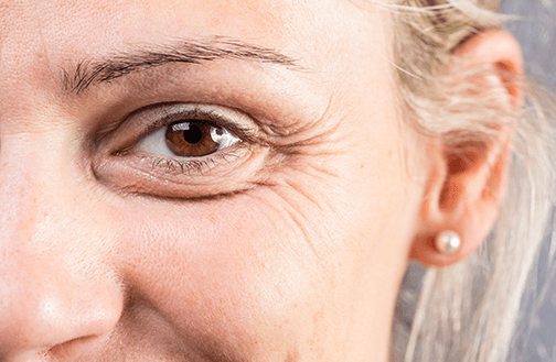 crows feet