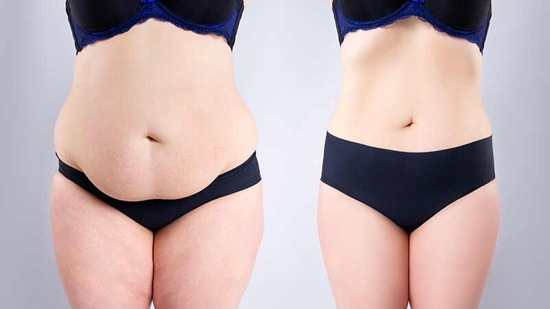 Debunking GLP-1 Myths: The Truth About Medical Weight Loss