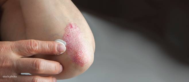 psoriasis treatments