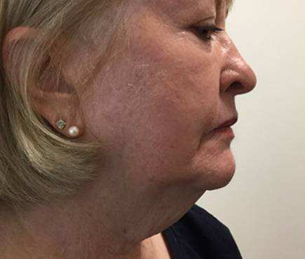 kybella side before
