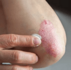 psoriasis