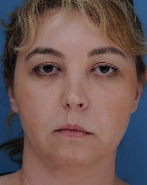 patient 100191 lip implants front view before