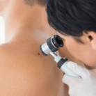 mohs surgery