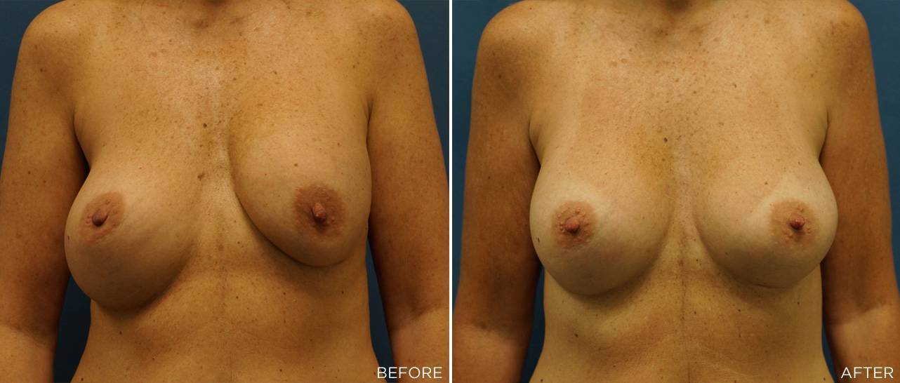 Patient A Implant Revision 