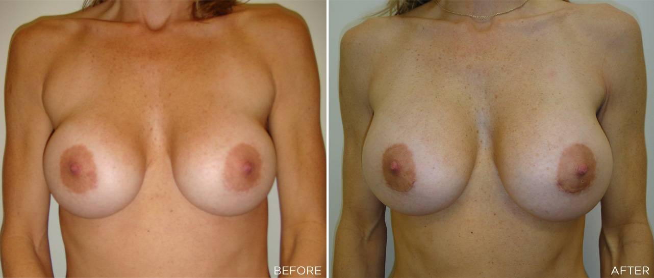 Patient G - Implant Revision 