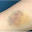 arm bruise