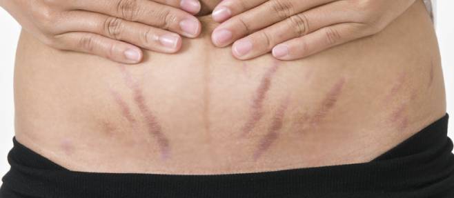 stretch marks