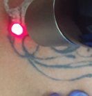 how soon for tattoo removal