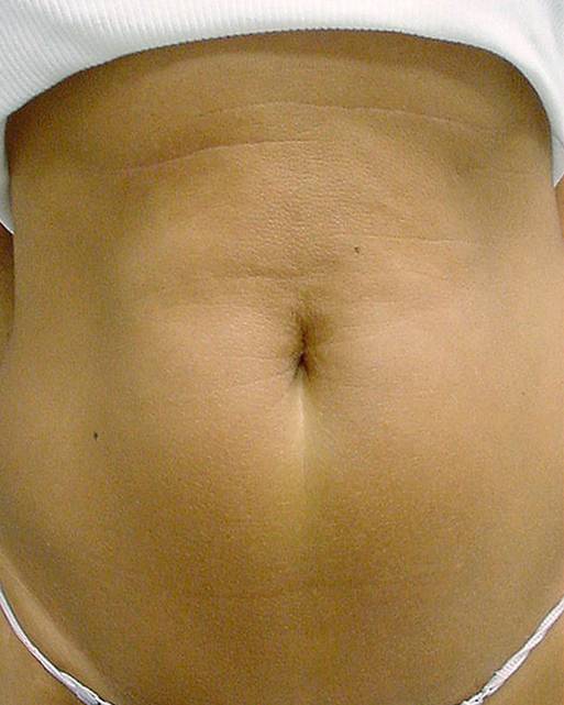 after thermage