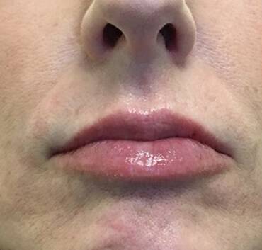 after volbella