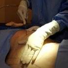smartlipo video