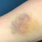 treat bruises