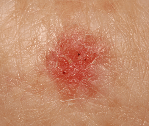 Bowen Disease