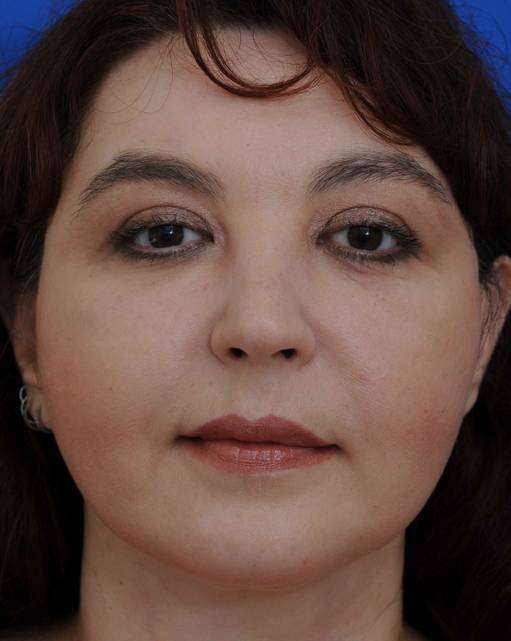 patient 100191 chin implant front view after