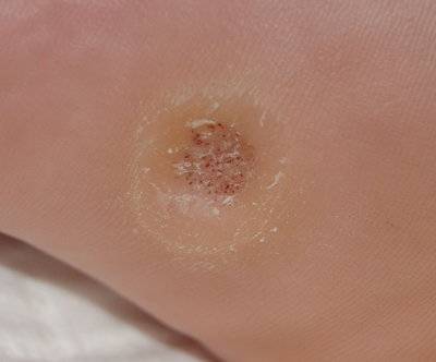plantar wart image