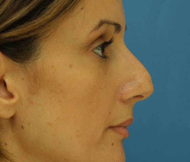 side rhinoplasty before
