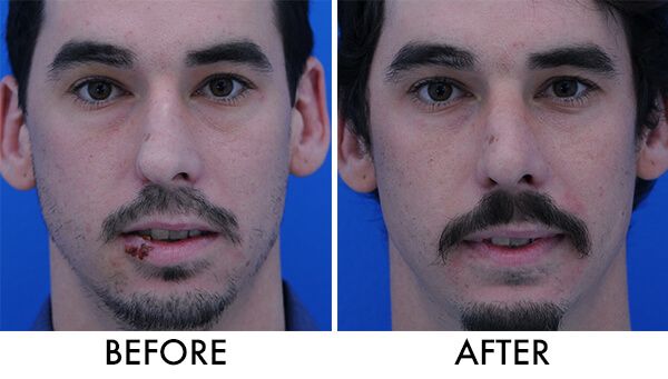 I-shaped nose correction