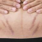 stretchmarks