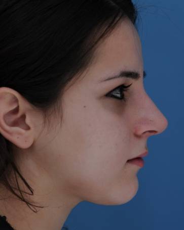 patient 100194 rhinoplasty side view after